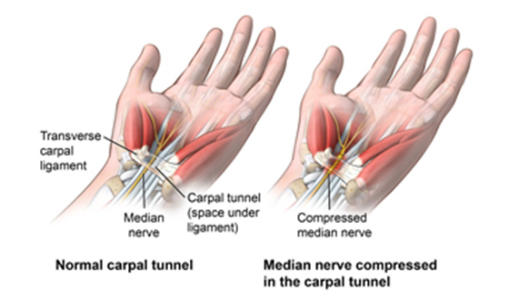 A diagram of two hands, one normal and one with the median nerve affected by carpal tunnel syndrome